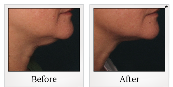 Before and After Photo 29 of Ultherapy treatment at SF Bay Cosmetic Surgery Medical Group in San Ramon