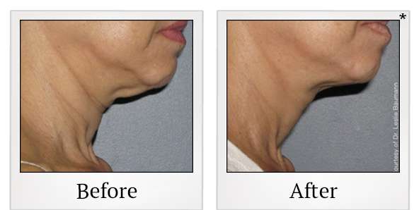 Before and After Photo 3 of Ultherapy treatment at SF Bay Cosmetic Surgery Medical Group in San Ramon