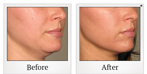 Before and After Photo 30 of Ultherapy treatment at SF Bay Cosmetic Surgery Medical Group in San Ramon