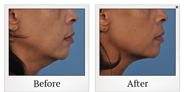 Before and After Photo 31 of Ultherapy treatment at SF Bay Cosmetic Surgery Medical Group in San Ramon