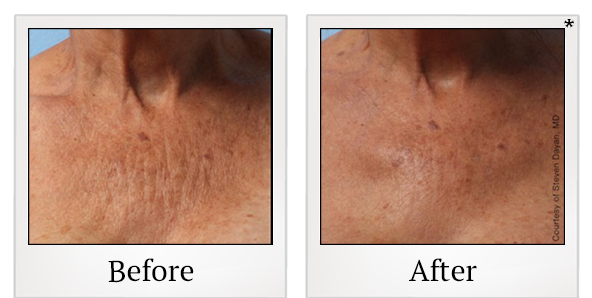 Before and After Photo 32 of Ultherapy treatment at SF Bay Cosmetic Surgery Medical Group in San Ramon