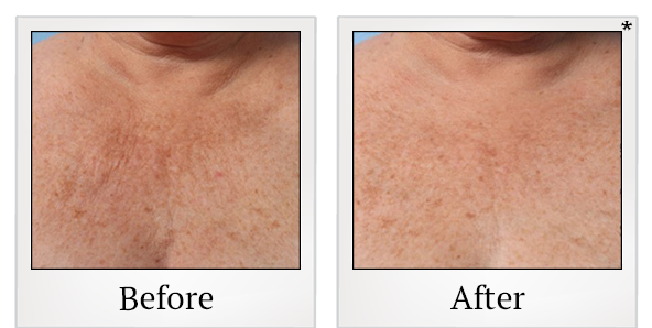 Before and After Photo 33 of Ultherapy treatment at SF Bay Cosmetic Surgery Medical Group in San Ramon