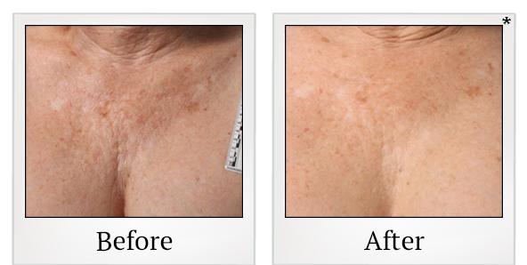 Before and After Photo 34 of Ultherapy treatment at SF Bay Cosmetic Surgery Medical Group in San Ramon