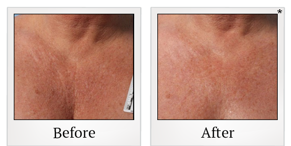 Before and After Photo 35 of Ultherapy treatment at SF Bay Cosmetic Surgery Medical Group in San Ramon