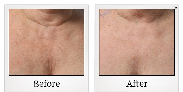 Before and After Photo 36 of Ultherapy treatment at SF Bay Cosmetic Surgery Medical Group in San Ramon