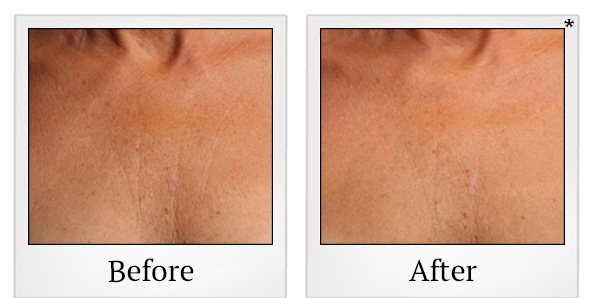 Before and After Photo 37 of Ultherapy treatment at SF Bay Cosmetic Surgery Medical Group in San Ramon