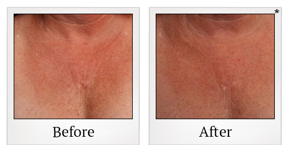 Before and After Photo 38 of Ultherapy treatment at SF Bay Cosmetic Surgery Medical Group in San Ramon