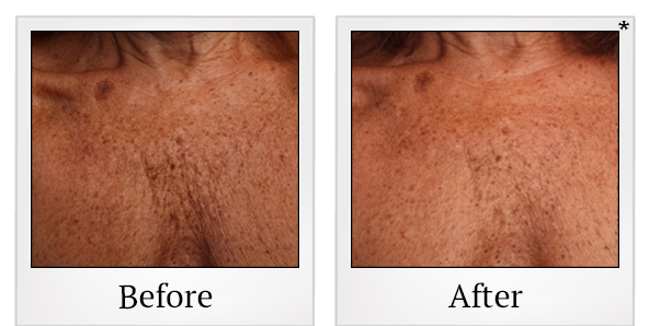 Before and After Photo 39 of Ultherapy treatment at SF Bay Cosmetic Surgery Medical Group in San Ramon
