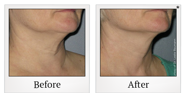 Before and After Photo 4 of Ultherapy treatment at SF Bay Cosmetic Surgery Medical Group in San Ramon