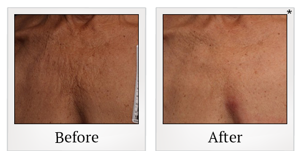 Before and After Photo 40 of Ultherapy treatment at SF Bay Cosmetic Surgery Medical Group in San Ramon