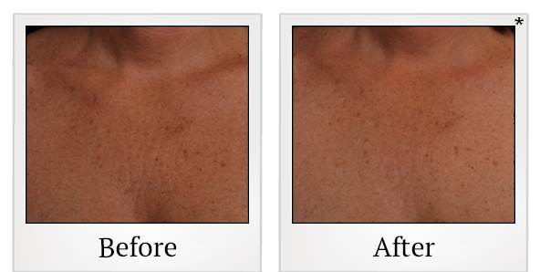 Before and After Photo 41 of Ultherapy treatment at SF Bay Cosmetic Surgery Medical Group in San Ramon