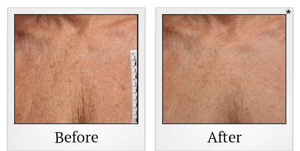 Before and After Photo 42 of Ultherapy treatment at SF Bay Cosmetic Surgery Medical Group in San Ramon