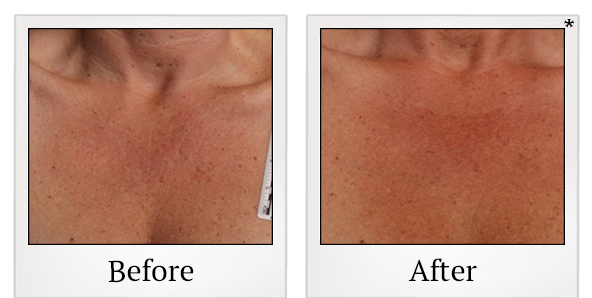 Before and After Photo 43 of Ultherapy treatment at SF Bay Cosmetic Surgery Medical Group in San Ramon
