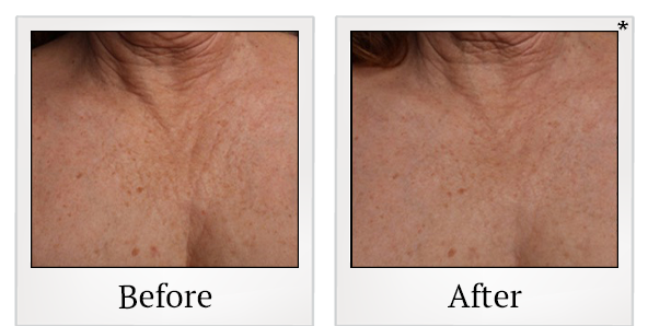 Before and After Photo 44 of Ultherapy treatment at SF Bay Cosmetic Surgery Medical Group in San Ramon
