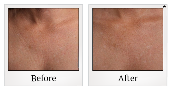 Before and After Photo 45 of Ultherapy treatment at SF Bay Cosmetic Surgery Medical Group in San Ramon