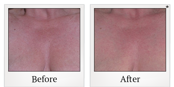 Before and After Photo 46 of Ultherapy treatment at SF Bay Cosmetic Surgery Medical Group in San Ramon
