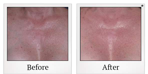 Before and After Photo 47 of Ultherapy treatment at SF Bay Cosmetic Surgery Medical Group in San Ramon