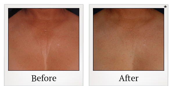 Before and After Photo 48 of Ultherapy treatment at SF Bay Cosmetic Surgery Medical Group in San Ramon