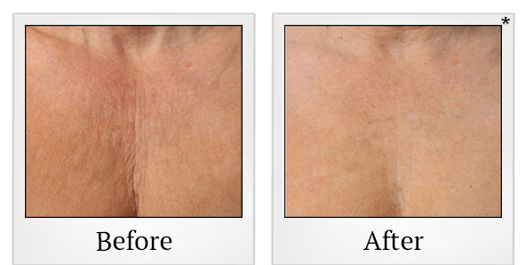 Before and After Photo 49 of Ultherapy treatment at SF Bay Cosmetic Surgery Medical Group in San Ramon