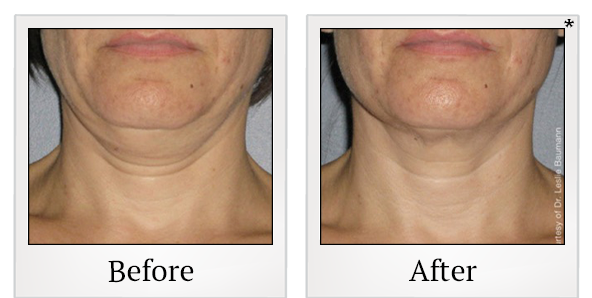 Before and After Photo 5 of Ultherapy treatment at SF Bay Cosmetic Surgery Medical Group in San Ramon