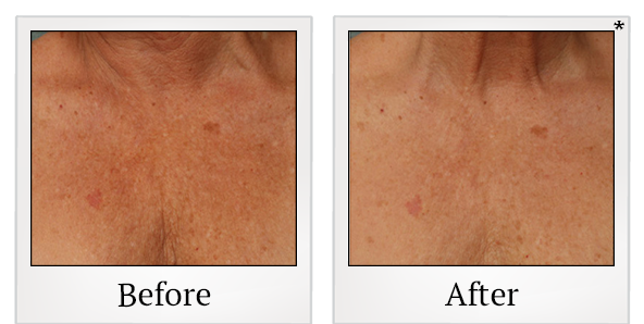 Before and After Photo 50 of Ultherapy treatment at SF Bay Cosmetic Surgery Medical Group in San Ramon