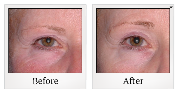 Before and After Photo 51 of Ultherapy treatment at SF Bay Cosmetic Surgery Medical Group in San Ramon