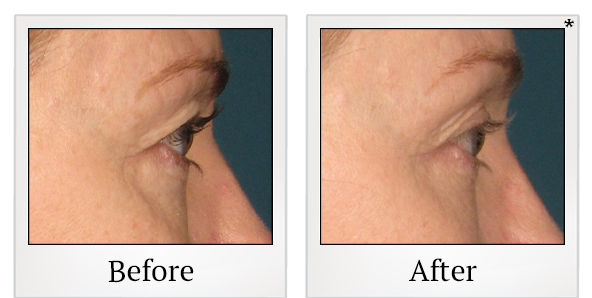 Before and After Photo 52 of Ultherapy treatment at SF Bay Cosmetic Surgery Medical Group in San Ramon