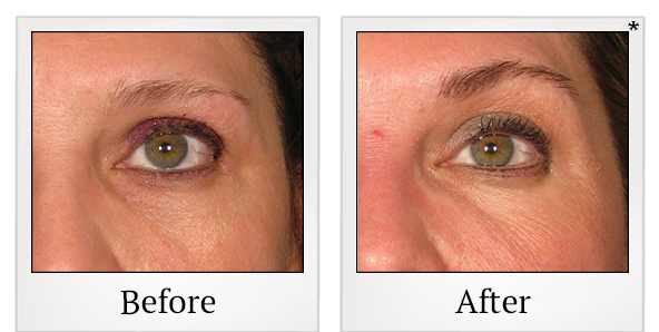 Before and After Photo 53 of Ultherapy treatment at SF Bay Cosmetic Surgery Medical Group in San Ramon