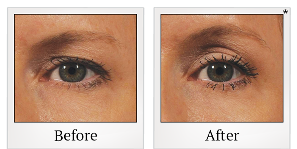 Before and After Photo 54 of Ultherapy treatment at SF Bay Cosmetic Surgery Medical Group in San Ramon