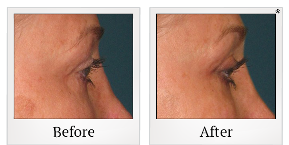 Before and After Photo 55 of Ultherapy treatment at SF Bay Cosmetic Surgery Medical Group in San Ramon