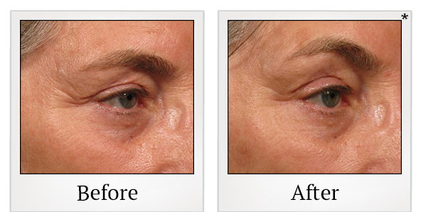Before and After Photo 56 of Ultherapy treatment at SF Bay Cosmetic Surgery Medical Group in San Ramon
