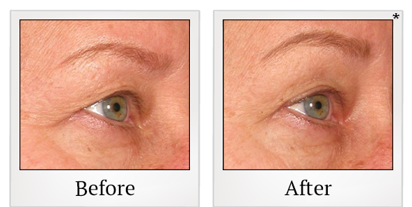 Before and After Photo 57 of Ultherapy treatment at SF Bay Cosmetic Surgery Medical Group in San Ramon