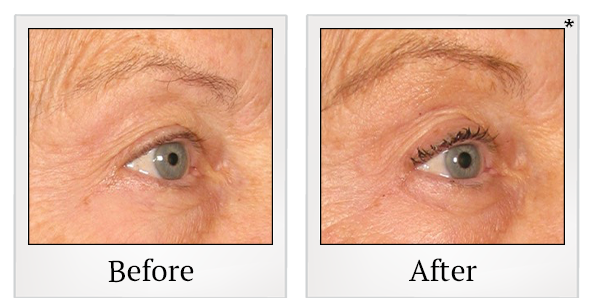 Before and After Photo 58 of Ultherapy treatment at SF Bay Cosmetic Surgery Medical Group in San Ramon