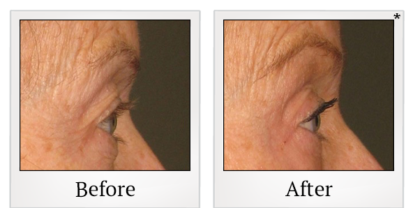 Before and After Photo 59 of Ultherapy treatment at SF Bay Cosmetic Surgery Medical Group in San Ramon