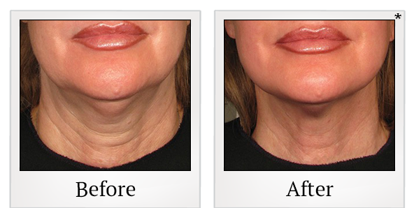 Before and After Photo 6 of Ultherapy treatment at SF Bay Cosmetic Surgery Medical Group in San Ramon