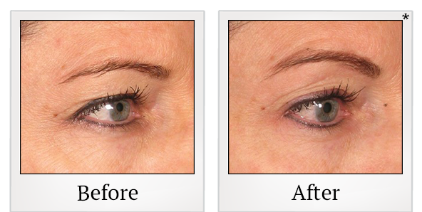 Before and After Photo 60 of Ultherapy treatment at SF Bay Cosmetic Surgery Medical Group in San Ramon