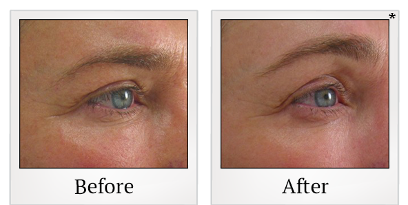 Before and After Photo 61 of Ultherapy treatment at SF Bay Cosmetic Surgery Medical Group in San Ramon
