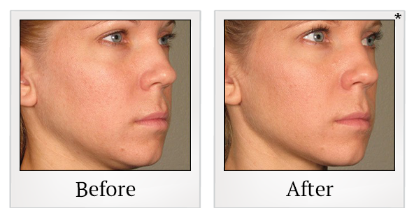 Before and After Photo 62 of Ultherapy treatment at SF Bay Cosmetic Surgery Medical Group in San Ramon