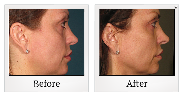 Before and After Photo 63 of Ultherapy treatment at SF Bay Cosmetic Surgery Medical Group in San Ramon