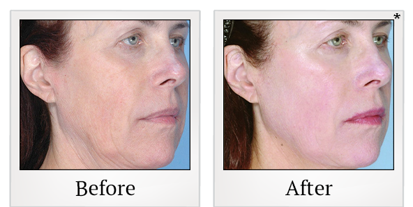 Before and After Photo 64 of Ultherapy treatment at SF Bay Cosmetic Surgery Medical Group in San Ramon