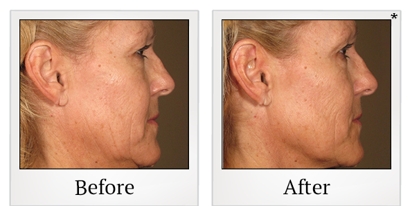Before and After Photo 65 of Ultherapy treatment at SF Bay Cosmetic Surgery Medical Group in San Ramon