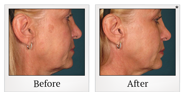 Before and After Photo 66 of Ultherapy treatment at SF Bay Cosmetic Surgery Medical Group in San Ramon