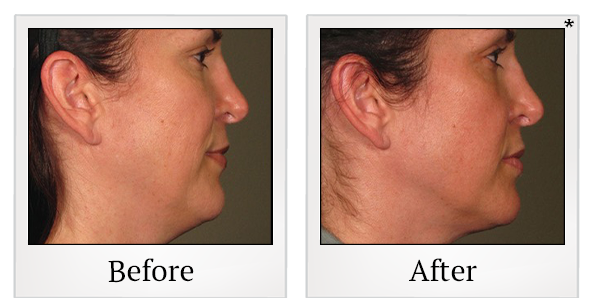 Before and After Photo 67 of Ultherapy treatment at SF Bay Cosmetic Surgery Medical Group in San Ramon