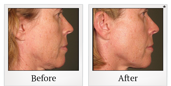 Before and After Photo 68 of Ultherapy treatment at SF Bay Cosmetic Surgery Medical Group in San Ramon