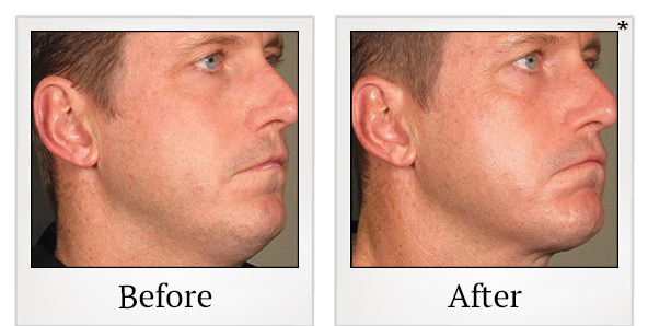 Before and After Photo 69 of Ultherapy treatment at SF Bay Cosmetic Surgery Medical Group in San Ramon