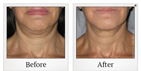 Before and After Photo 7 of Ultherapy treatment at SF Bay Cosmetic Surgery Medical Group in San Ramon