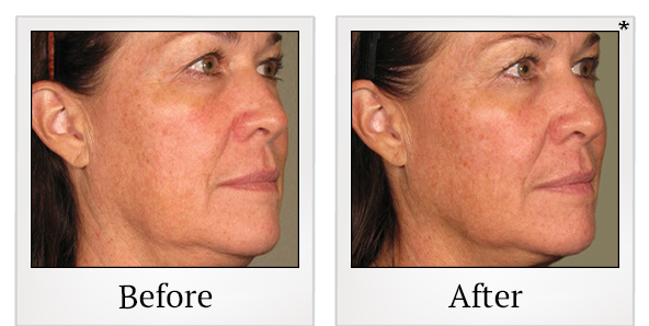 Before and After Photo 70 of Ultherapy treatment at SF Bay Cosmetic Surgery Medical Group in San Ramon