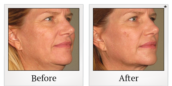Before and After Photo 71 of Ultherapy treatment at SF Bay Cosmetic Surgery Medical Group in San Ramon