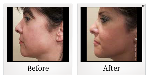 Before and After Photo 2 of Ultherapy® treatment at SF Bay Cosmetic Surgery Medical Group in San Ramon