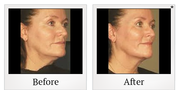 Before and After Photo 3 of Ultherapy® treatment at SF Bay Cosmetic Surgery Medical Group in San Ramon